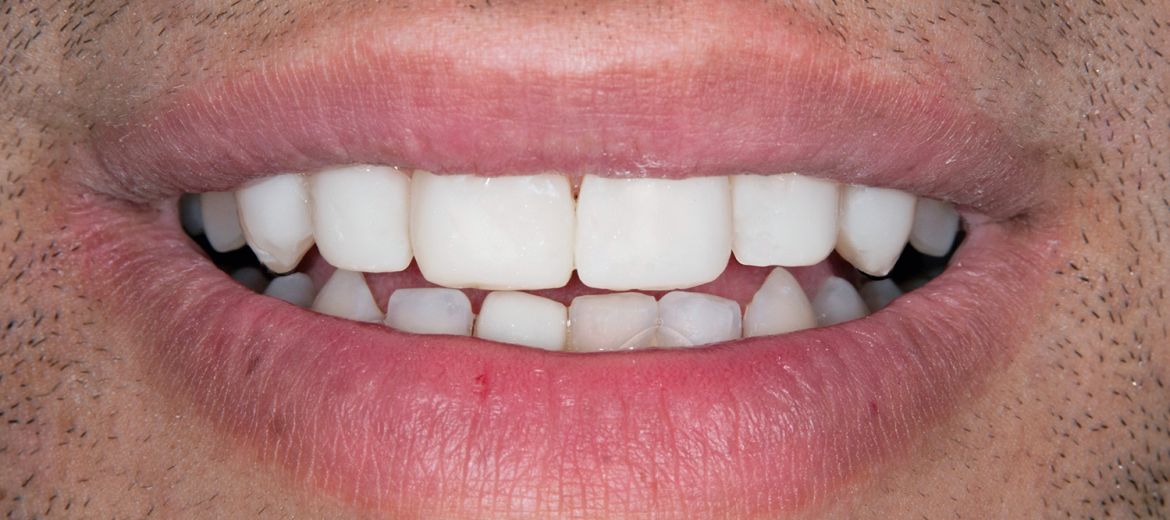 Veneers