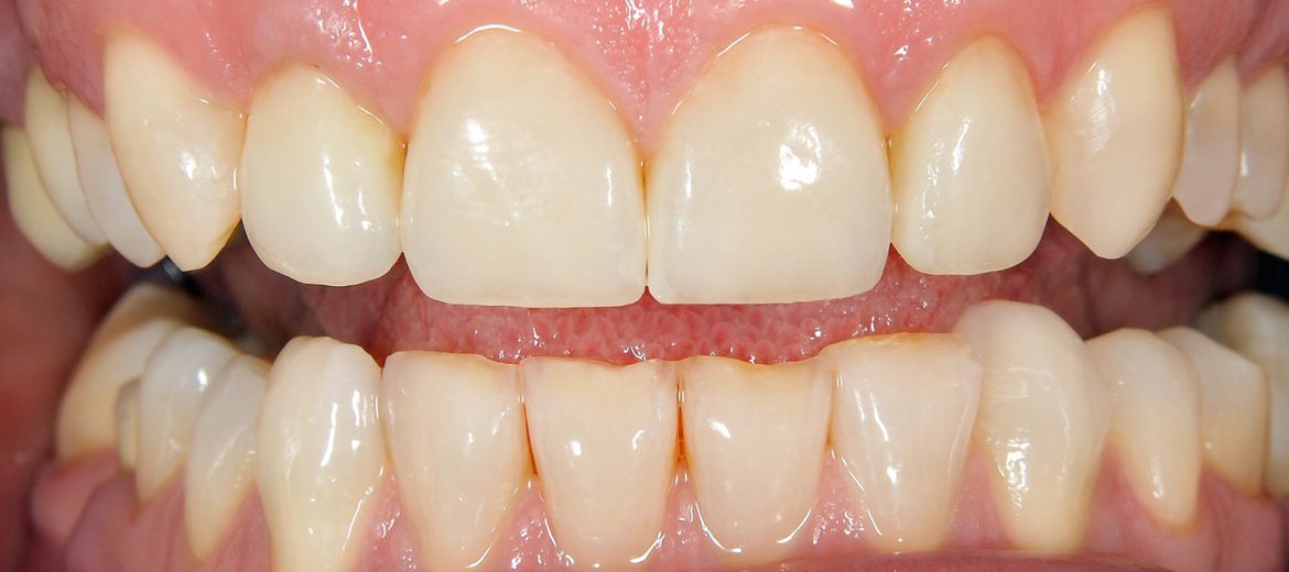 Composite Bonding