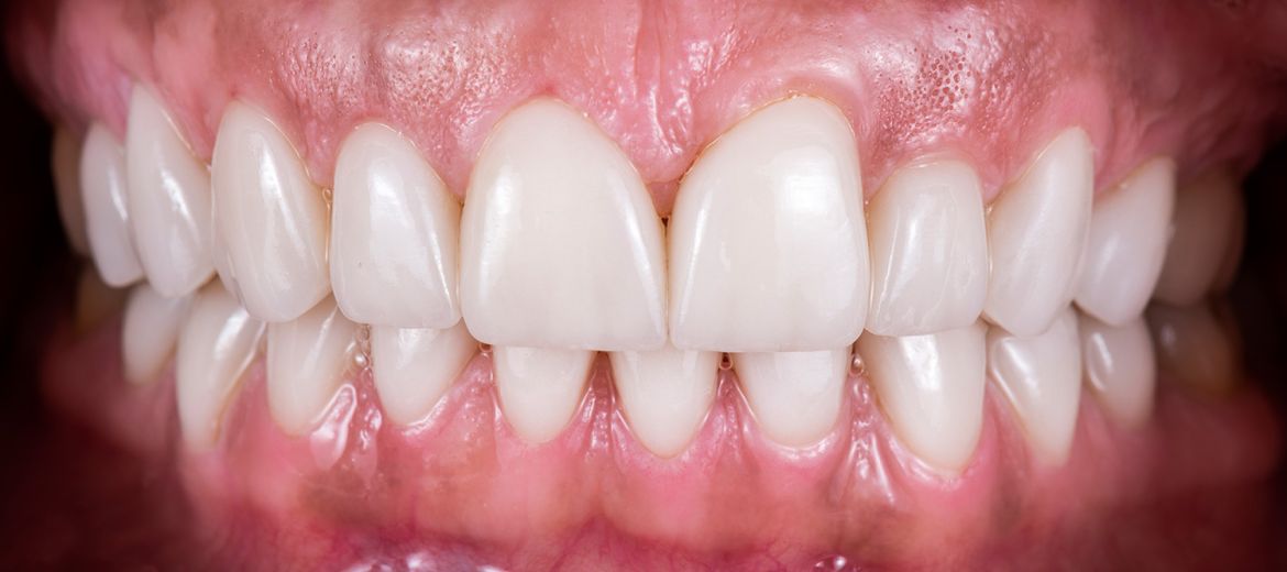 Dental Crowns