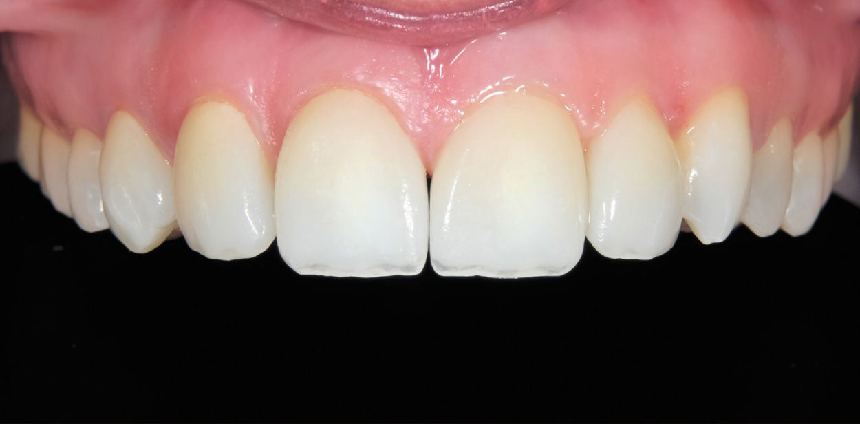 Close-up of teeth after composite bonding treatment at Atkinson Brignall