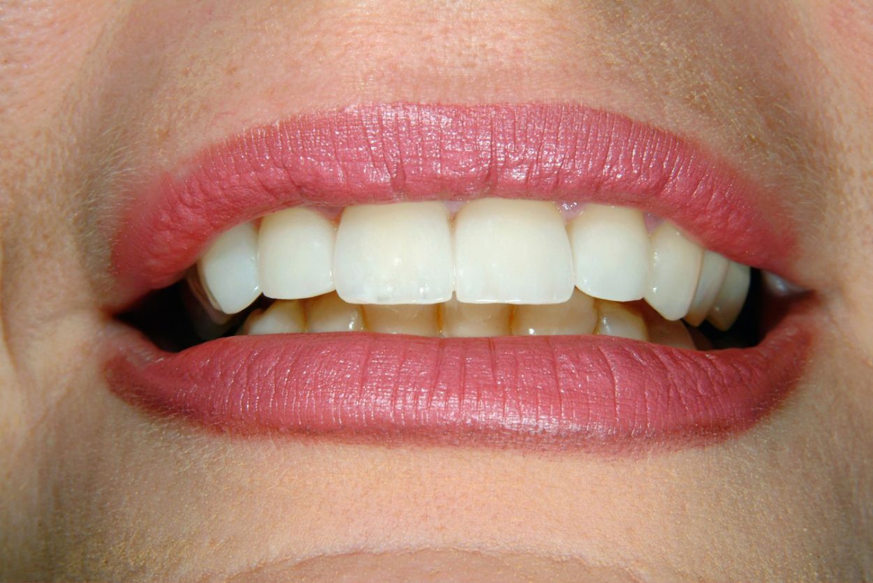 Confident smile after emergency dental treatment at Atkinson Brignall