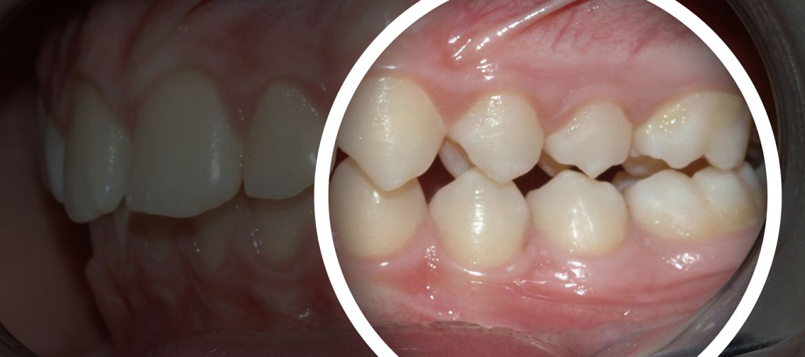 Dentures