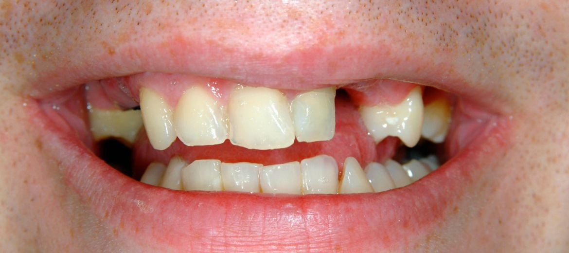 Dental Bridges