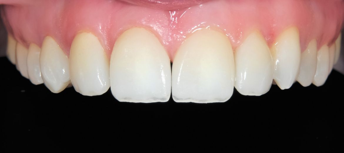 Invisalign / Clear Aligners