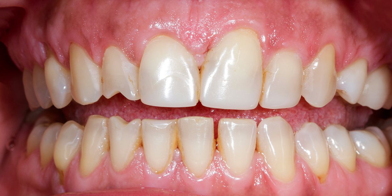 Smile before dental bridge treatment at Atkinson Brignall
