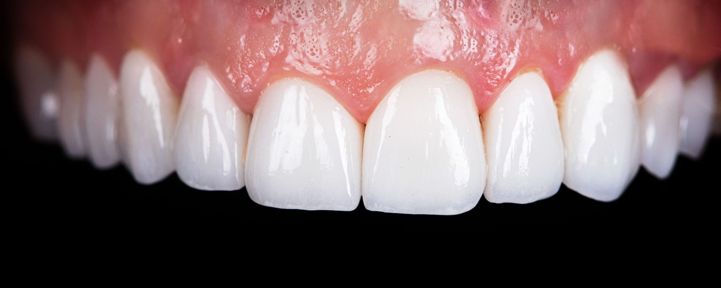 Dental Crowns