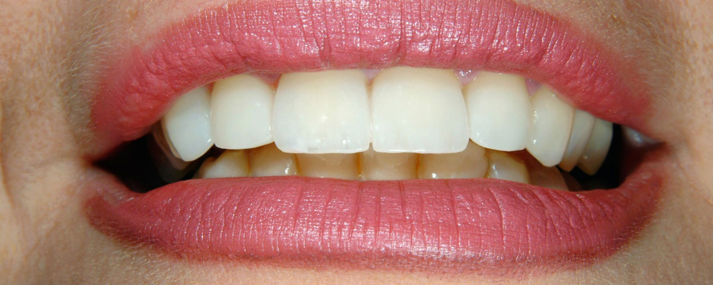 Veneers