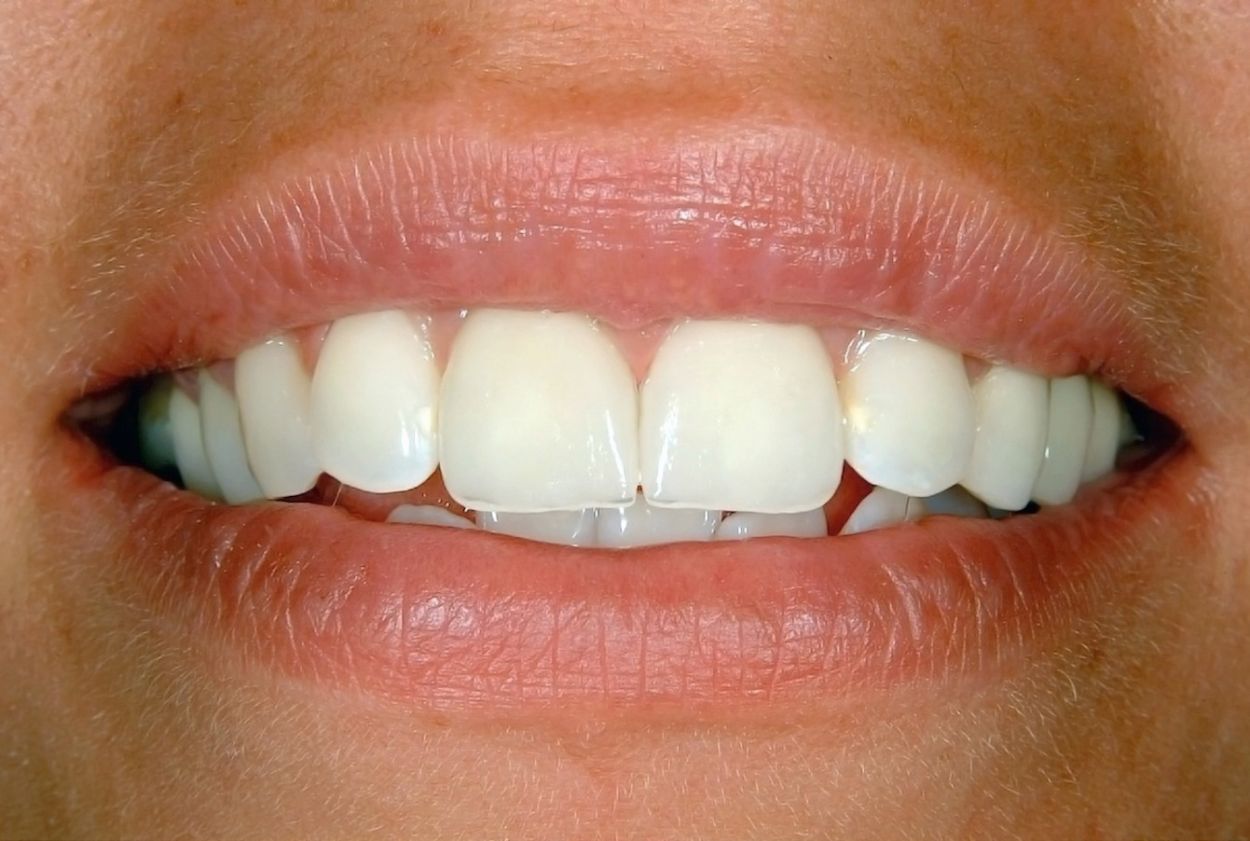 Smiling patient showing healthy teeth after denture treatment at Atkinson Brignall