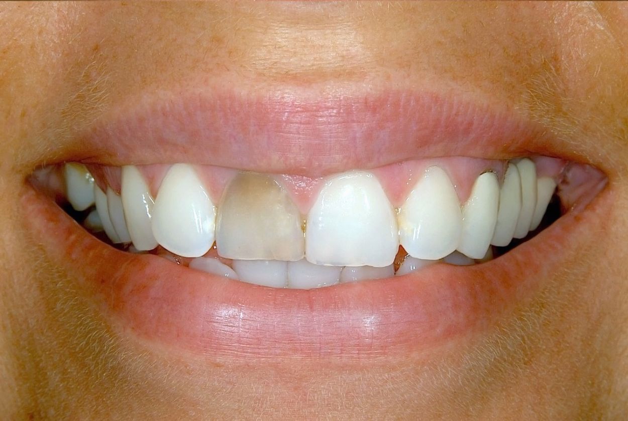 Smile before dental crown treatment at Atkinson Brignall