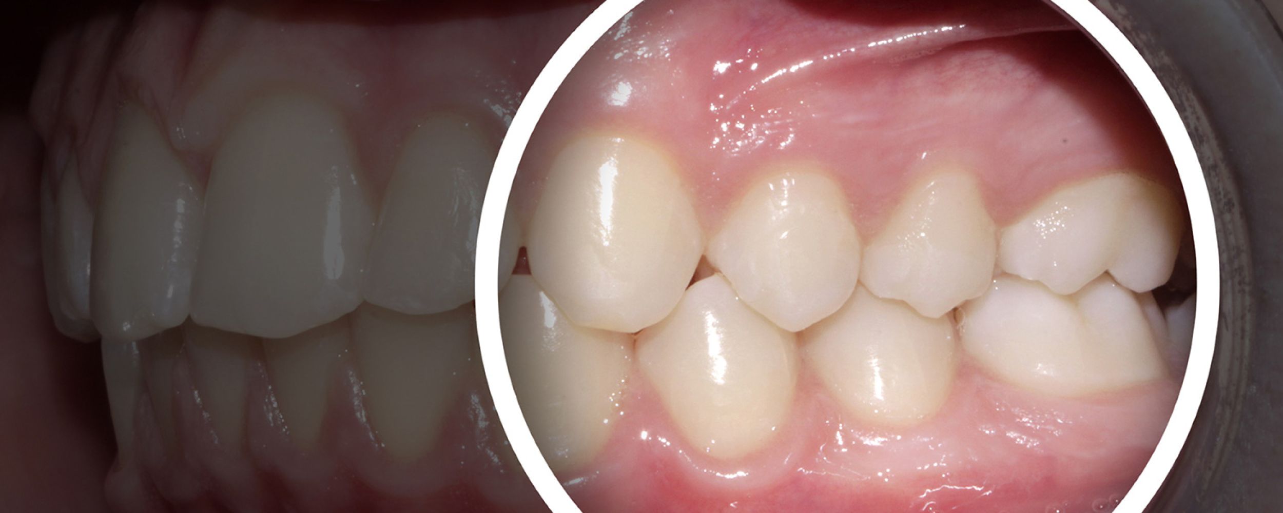 Dentures