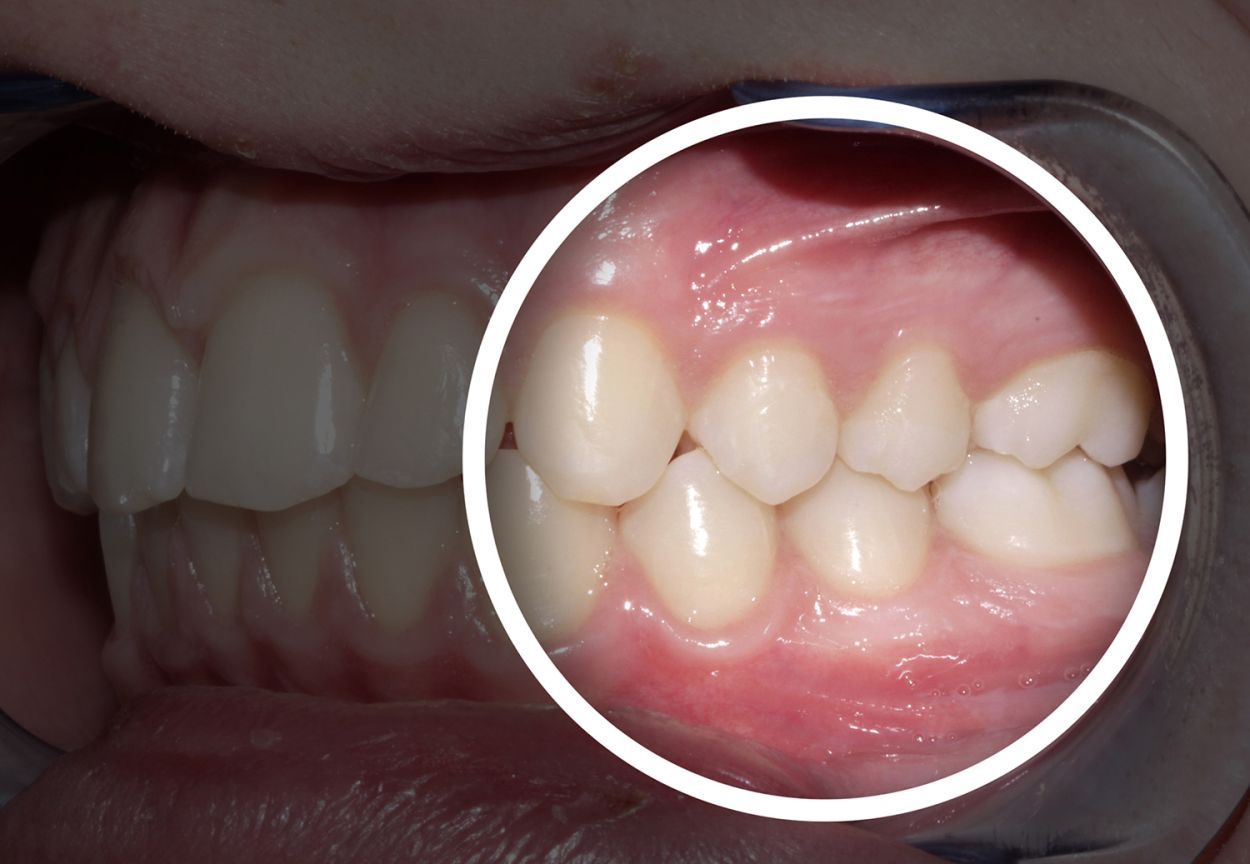 Straight, even smile achieved with Invisalign clear aligners at Atkinson Brignall