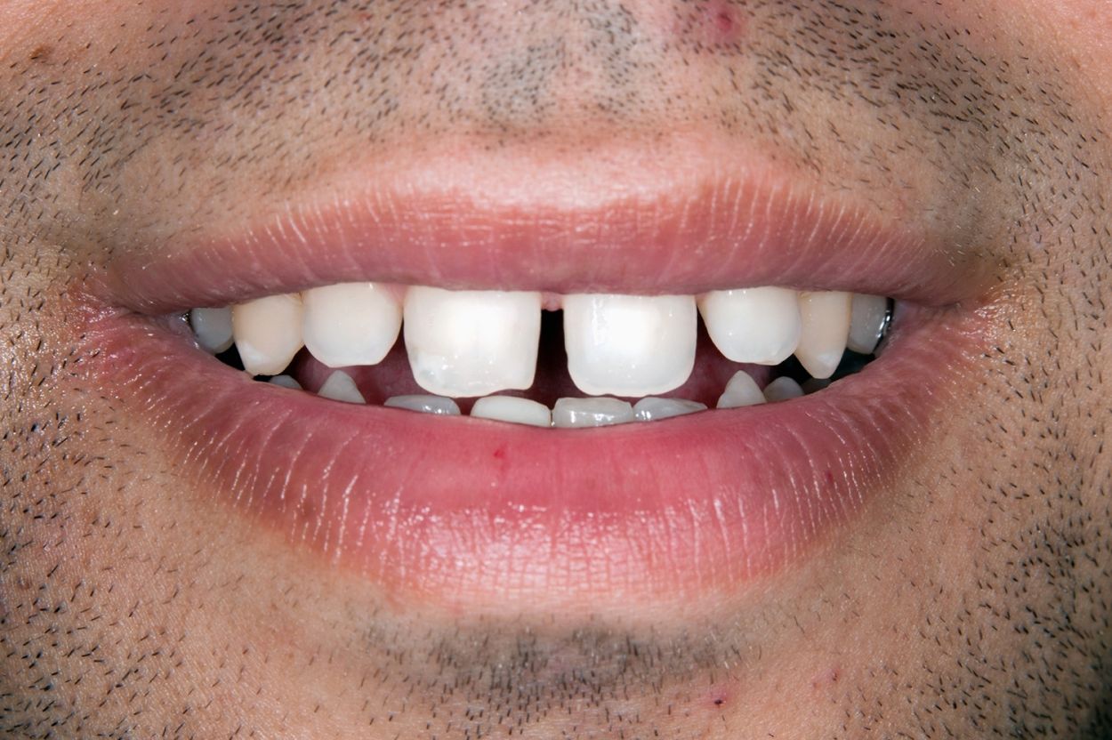 Close up of teeth before porcelain veneer treatment at Atkinson Brignall