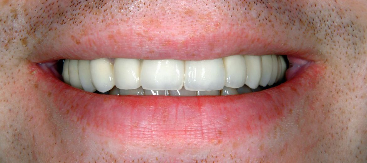 Dental Implants
