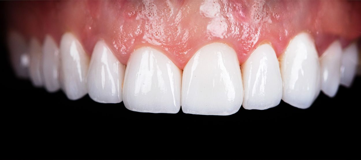 Bright white smile after professional teeth whitening at Atkinson Brignall